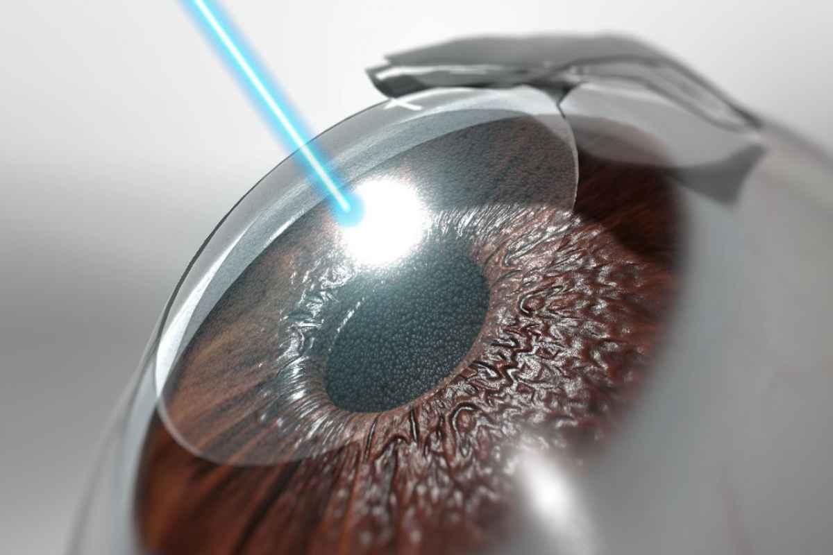 مزایا و معایب عمل لازک چشم - بینایی سنجی نور